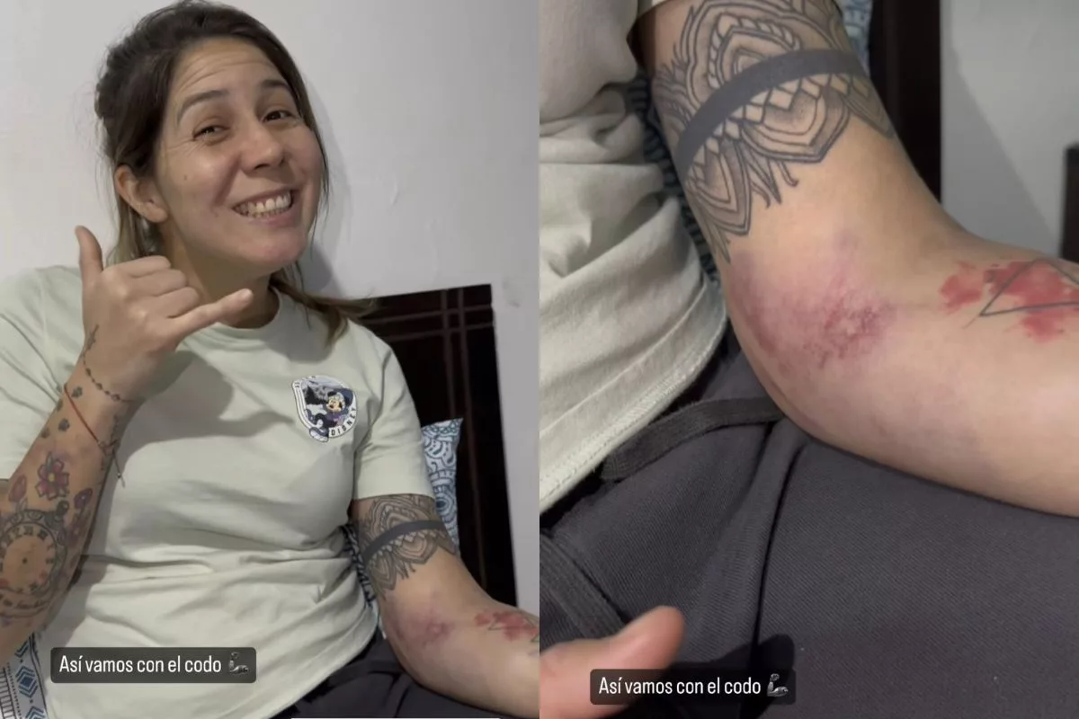 Doloroso: Así quedó el codo de Carla Guerrero tras su lesión en el Superclásico femenino